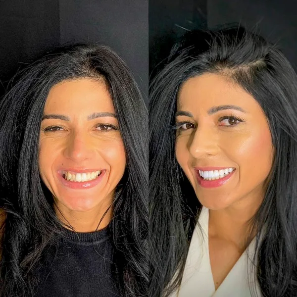 Juliana, paciente da Clinica ODOMED, antes e depois das lentes de contato dental